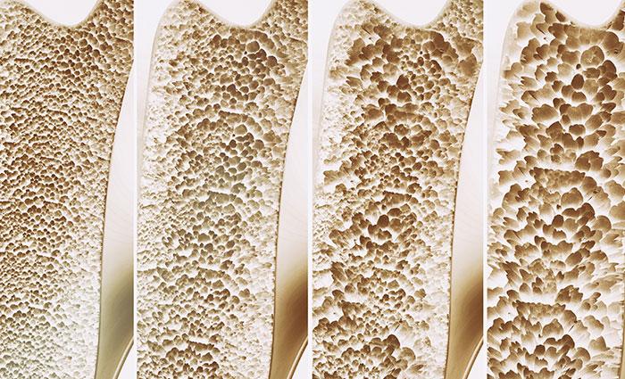osteoporoz-kemik erimesi